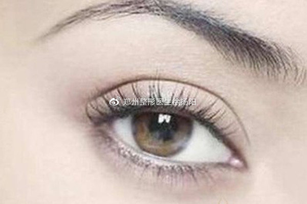 哪些人不适合做脸部吸脂,全切双眼皮吸脂和不吸脂的区别