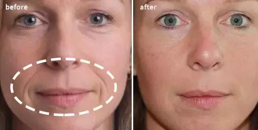 硬刚女皇龙妈也扛不住法令纹，2条沟壑让人心疼，贴一贴就消了