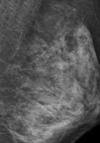 乳房按摩造成乳腺受伤,乳房按摩的不良后果