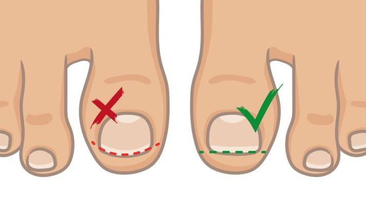 指甲全是竖条纹和白点是怎么回事,指甲竖条纹没有月牙怎么回事