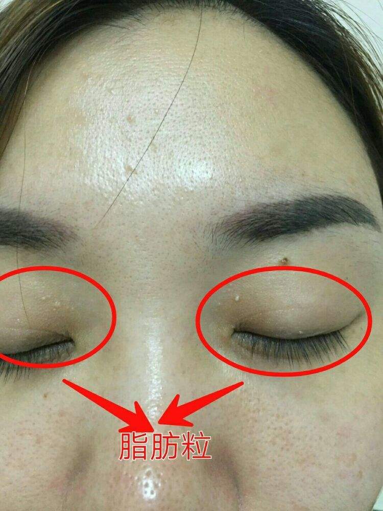 眼角有脂肪粒怎么祛除,眼角有脂肪粒怎么去掉