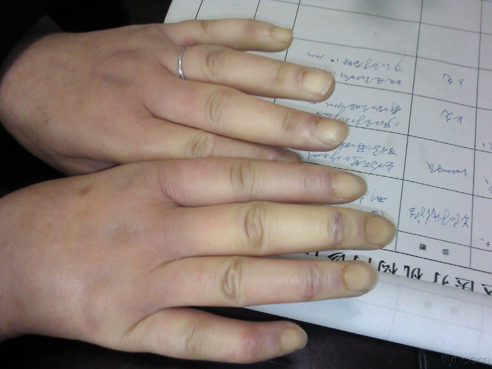 小儿免疫球蛋白iga偏低是什么原因,先天性免疫球蛋白缺乏症能治好吗