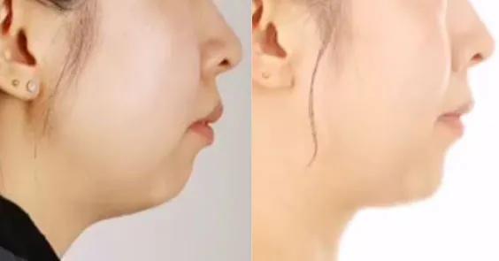 侧颜很难看是因为什么,侧颜不好看怎么修