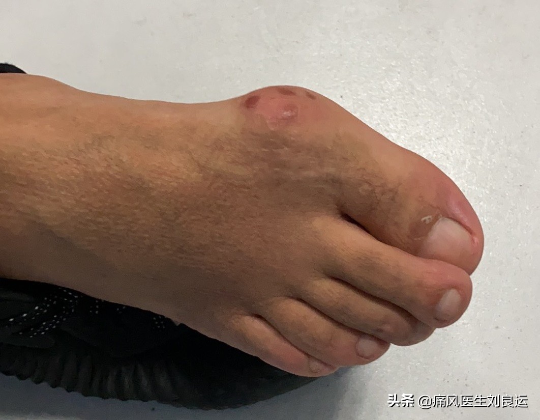 尿酸高除了注意饮食还需要什么,尿酸高有什么办法预防痛风发作