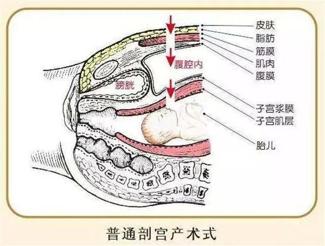 第3次剖宫产38周剖腹产可以吗,第3次剖腹产38周可以吗