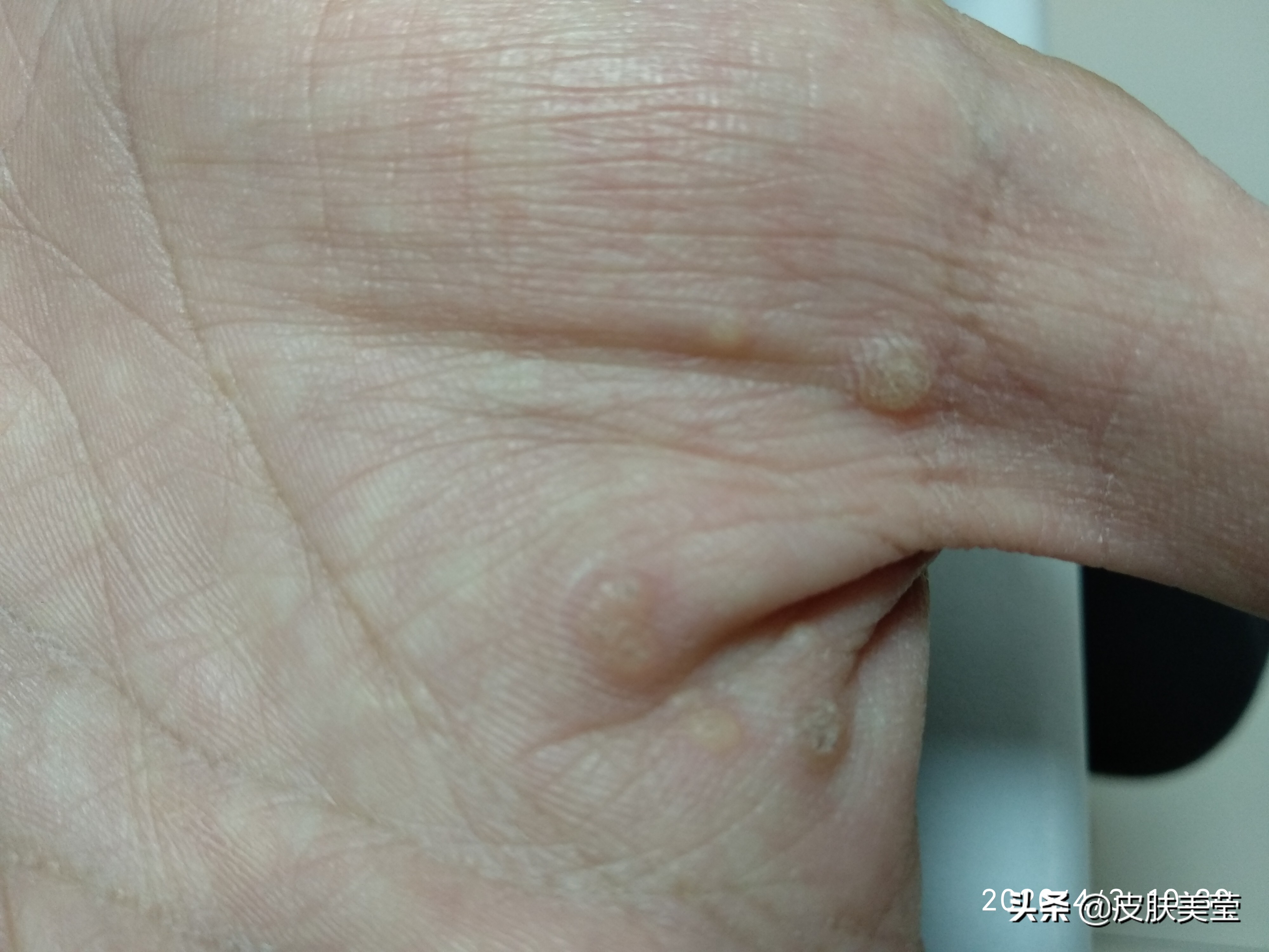 接种hpv疫苗可以预防其他癌症吗,hpv疫苗会让人感染hpv病毒吗