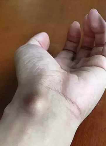 腱鞘囊肿怎么办,腱鞘囊肿用什么药膏