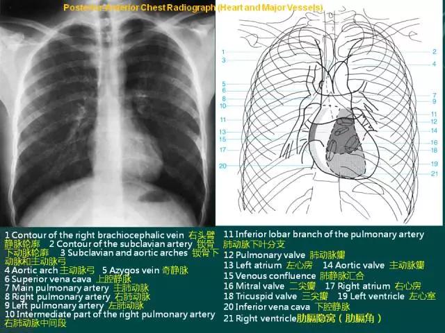 纵隔人体解剖学,纵隔解剖x线表现