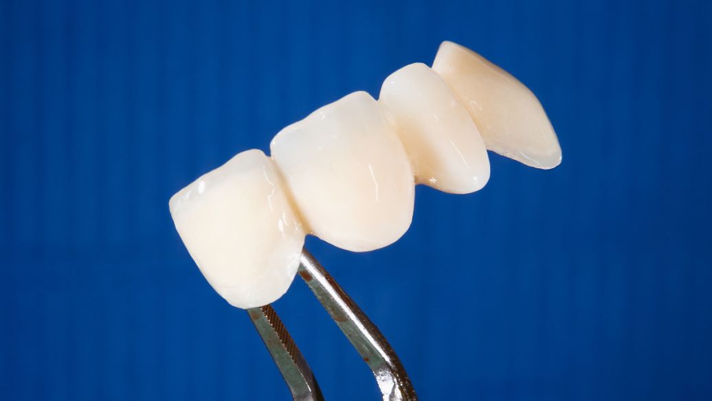 烤瓷牙崩瓷修复的详细步骤,烤瓷牙崩瓷必须更换吗