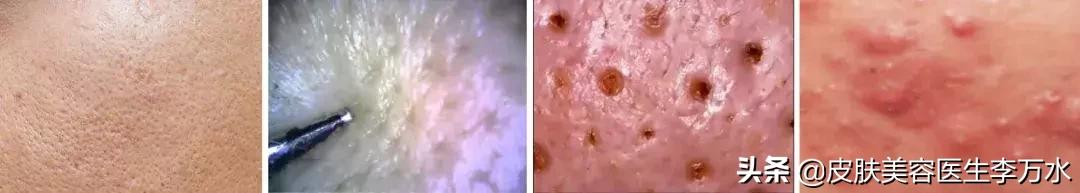 大油皮的坏处是什么,大油皮为啥还起皮