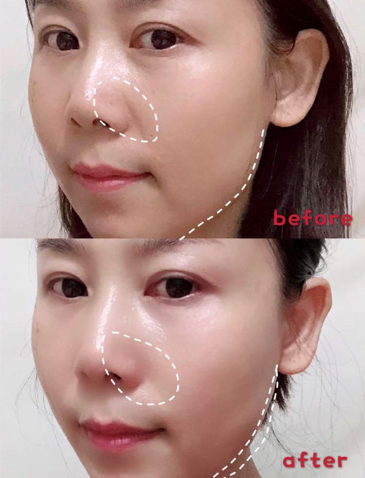 打水光针和打除皱针哪种好,打水光针和除皱针哪个好