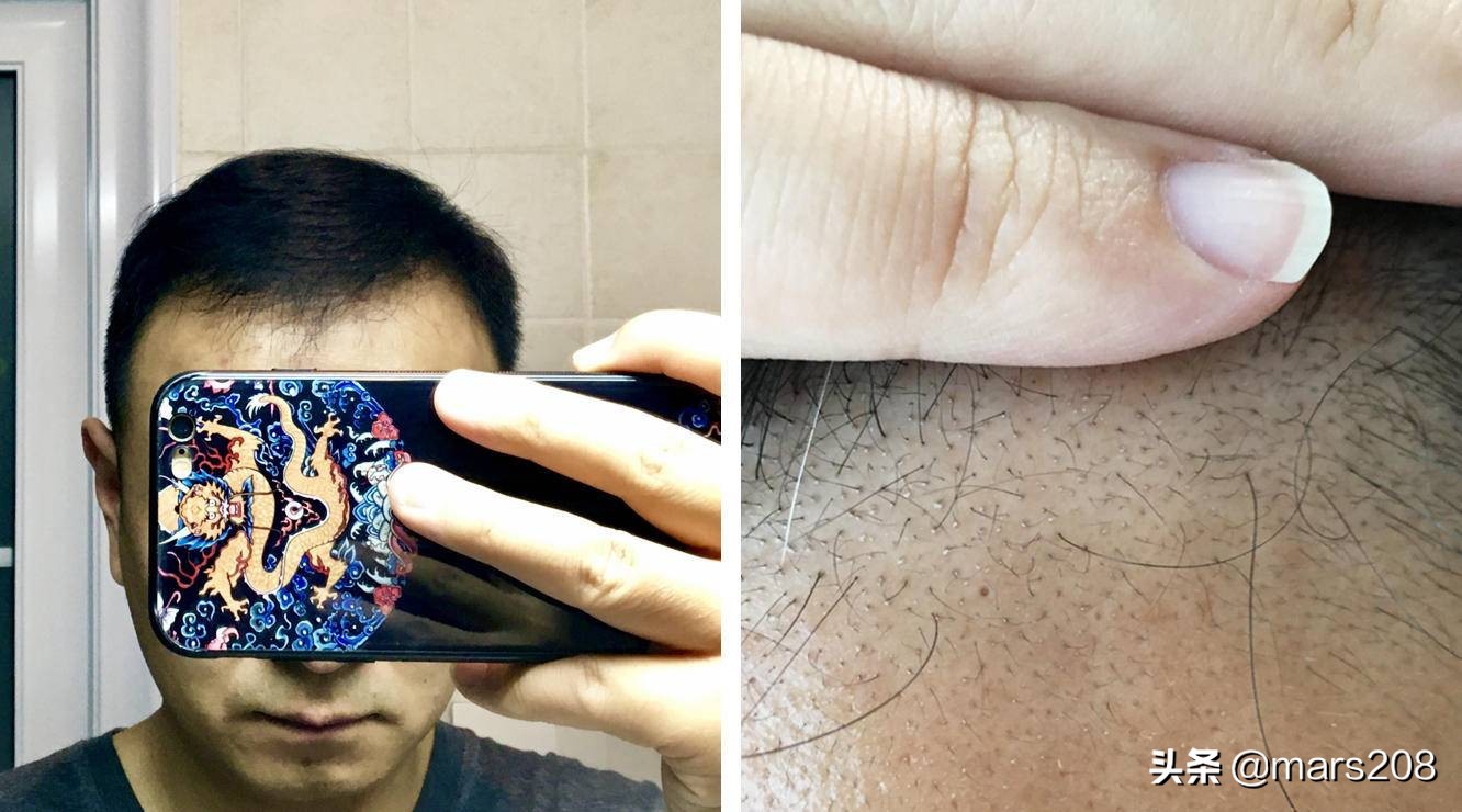 保卫发际线,防脱路上的13款防脱洗护用品使用感受