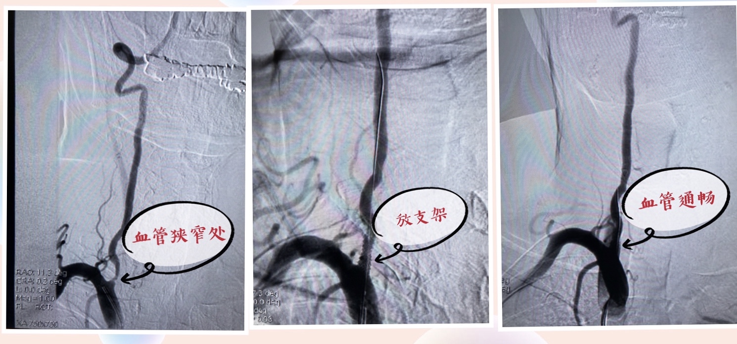 b超检查发现血管里有斑块怎么办,b超检查颈部斑块已形成