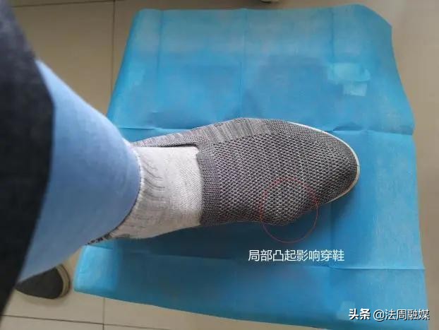 拇指长歪了?别慌!常德市第一中医医院专家帮您改“邪”归正