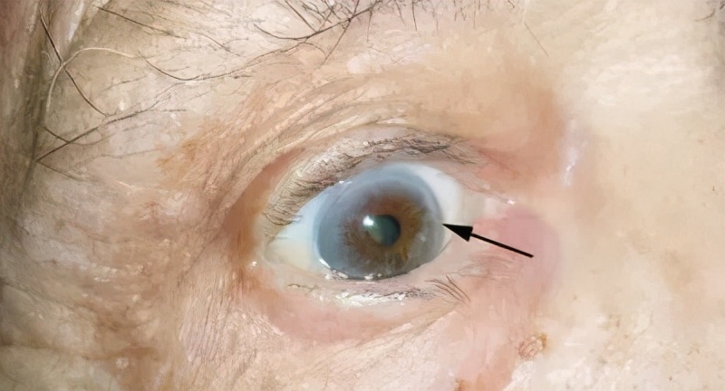 心脏引起的眼皮肿的图片,心血管病人眼睛充血怎么回事