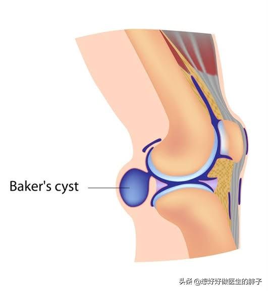 辟谣囊肿手术,得了囊肿必须切除么