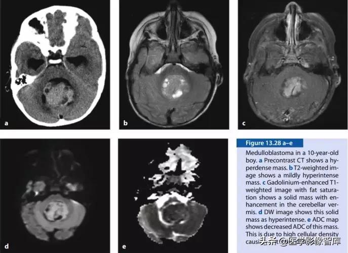 双侧额叶皮层区dwi偏高是什么意思,颅内dwi高信号病变