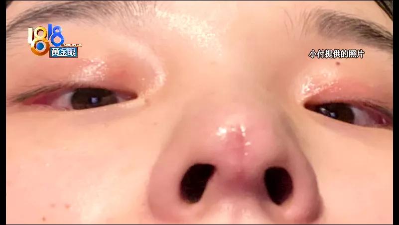 鼻部做了手术如何消除疤,鼻部修复恢复要多久