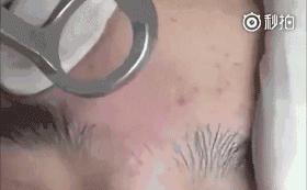 化妆品祛斑和激光祛斑哪个效果好,祛斑可以去医院但不要激光祛斑