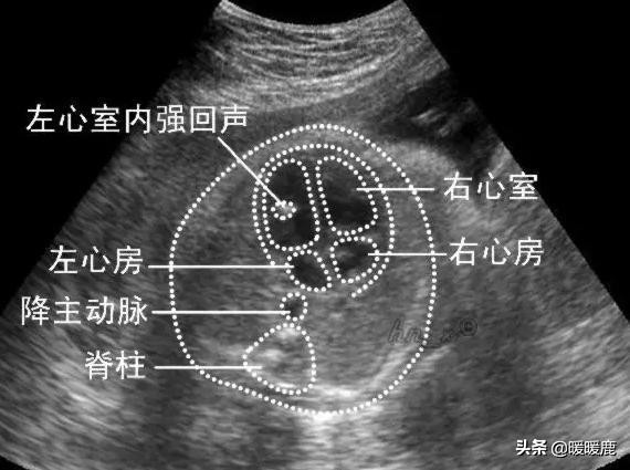 孕期如何通过b超看胎儿大小,三分钟看懂孕期b超图