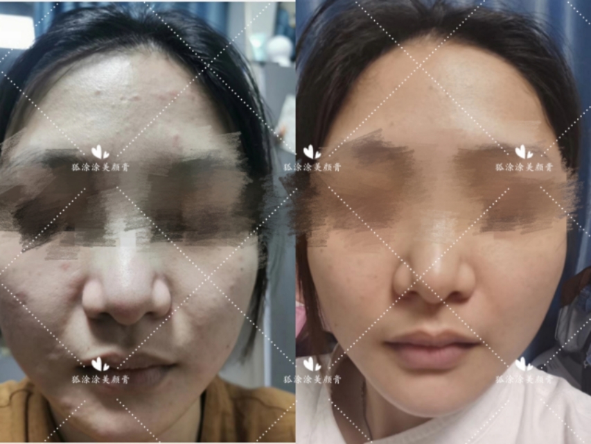 什么产品祛痘痘痘印效果好呢,祛痘印最好用的产品