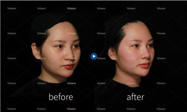 “轻医美“的灵魂捕手爱美客，颜值红利洼地中的“玻尿酸第一股”