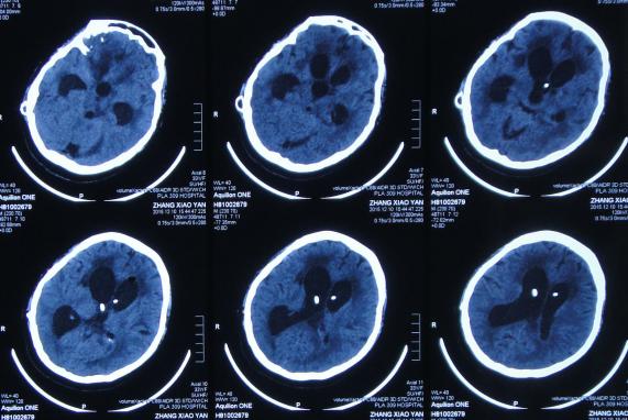 结核性脑积水,脑膜炎脑积水要治疗多久