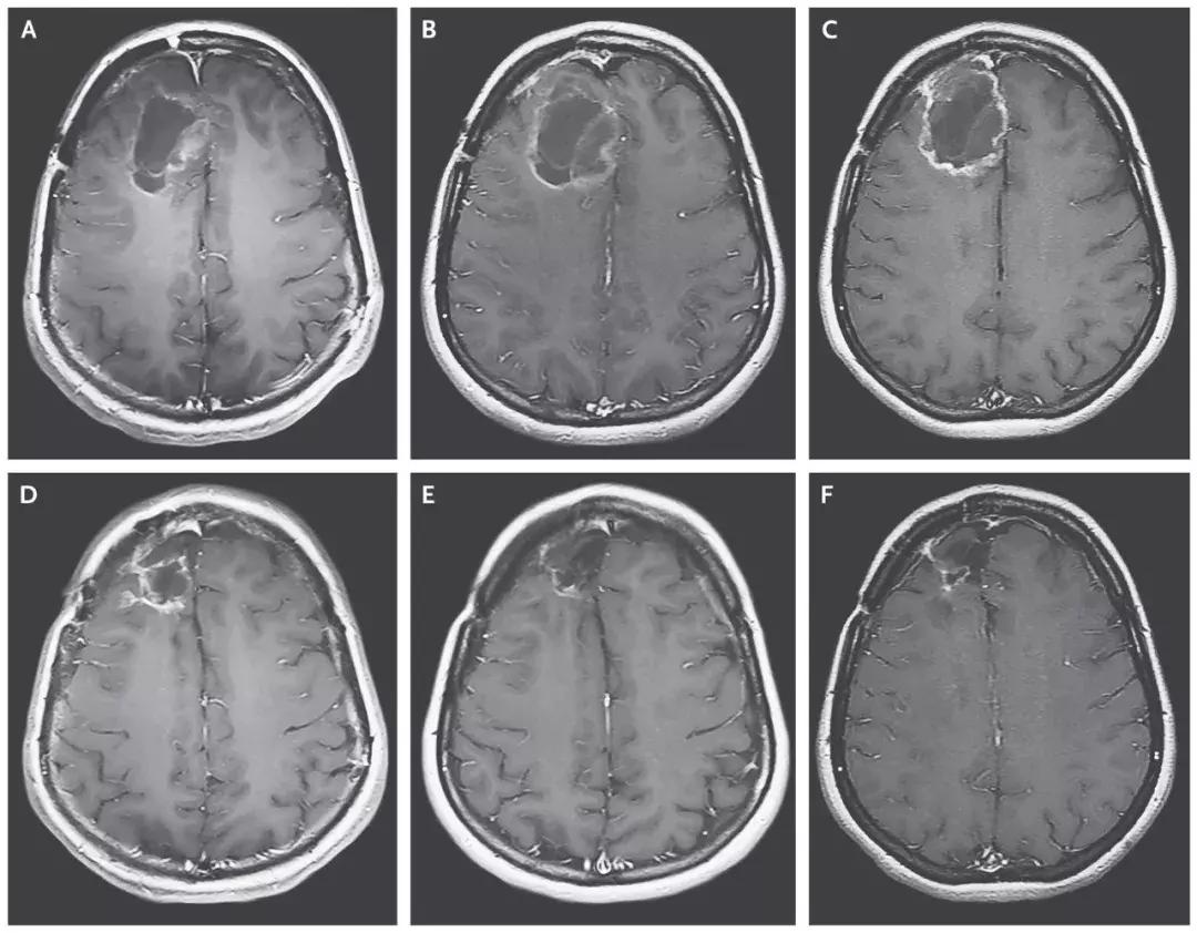 2019抗癌治疗,5分钟全面了解癌症的免疫治疗