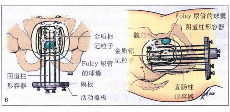 居民常见恶性肿瘤筛查和预防推荐,女人常见的肿瘤