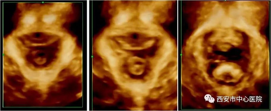 【大写的尴尬】大笑咳嗽时尿*禁失**了——四维超声带你认识盆底健康