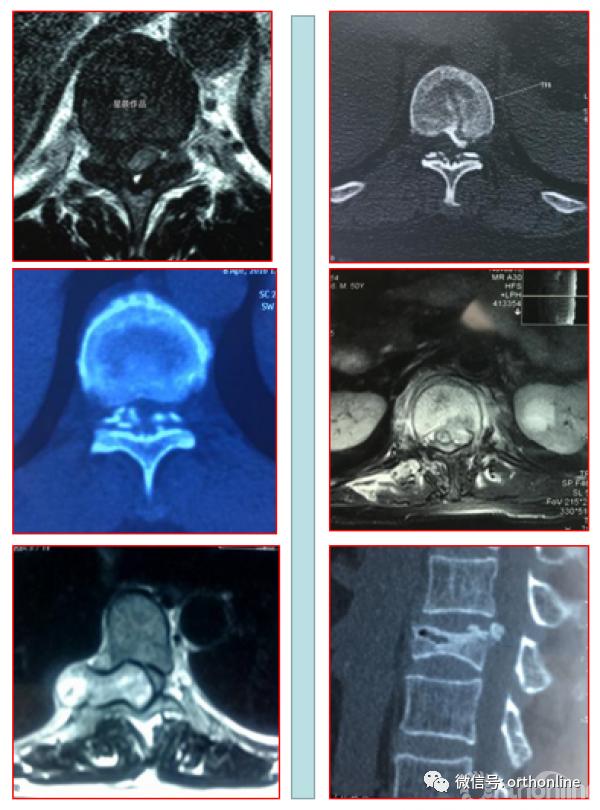 胸椎怎么做微创,脊柱内镜微创操作流程