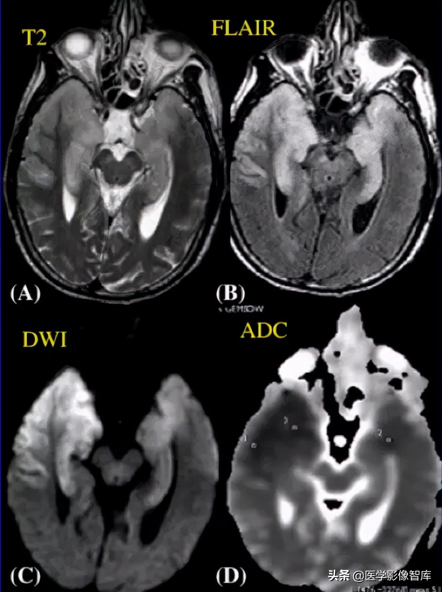 双侧额叶皮层区dwi偏高是什么意思,颅内dwi高信号病变