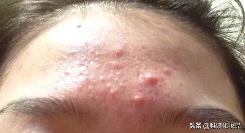 脸上部位长痘痘的原因分析图,脸上哪个部位长痘痘代表什么