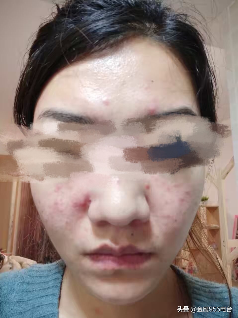800元祛痘竟毁容,祛痘毁容800元