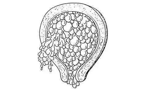 什么情况容易导致葡萄胎,怀孕葡萄胎有哪些特征