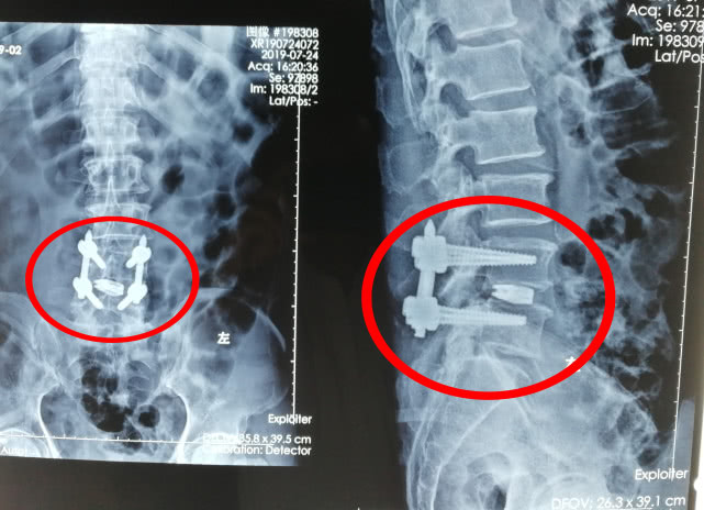 86岁老人腰椎病可以做微创手术吗,台商大叔