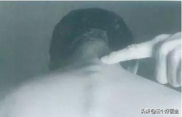 脊椎错位现场如何处理,脊椎错位矫正方法图解