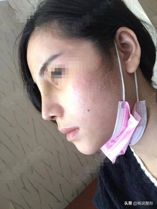 隆鼻失败的常见原因有哪些,隆鼻失败最快的解决方法