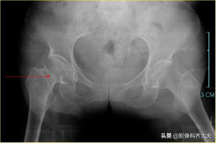 骨折的影像学检查及各自的优势,骨折的影像学愈合标准