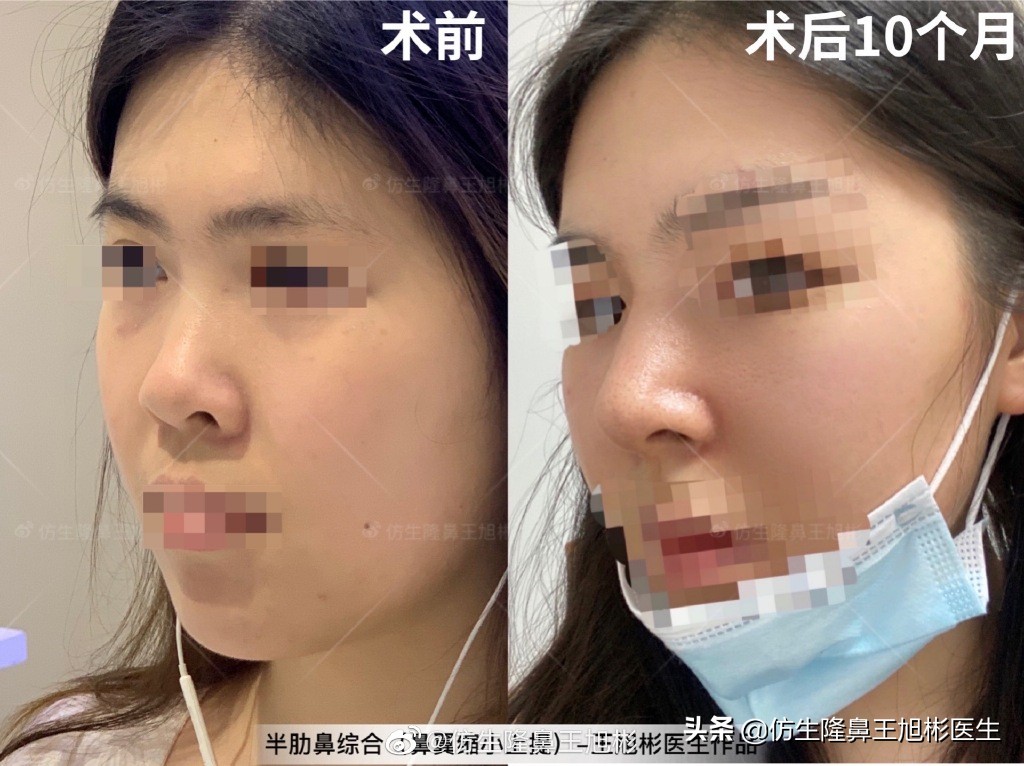 那些被鼻子“封印”颜值的鼻综合/修复案例|广州鼻整形
