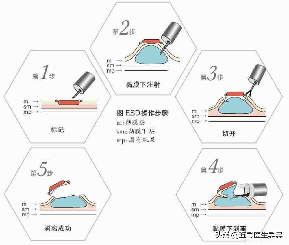 关于“大肠息肉”的6个问题，搞清楚再去检查也不迟