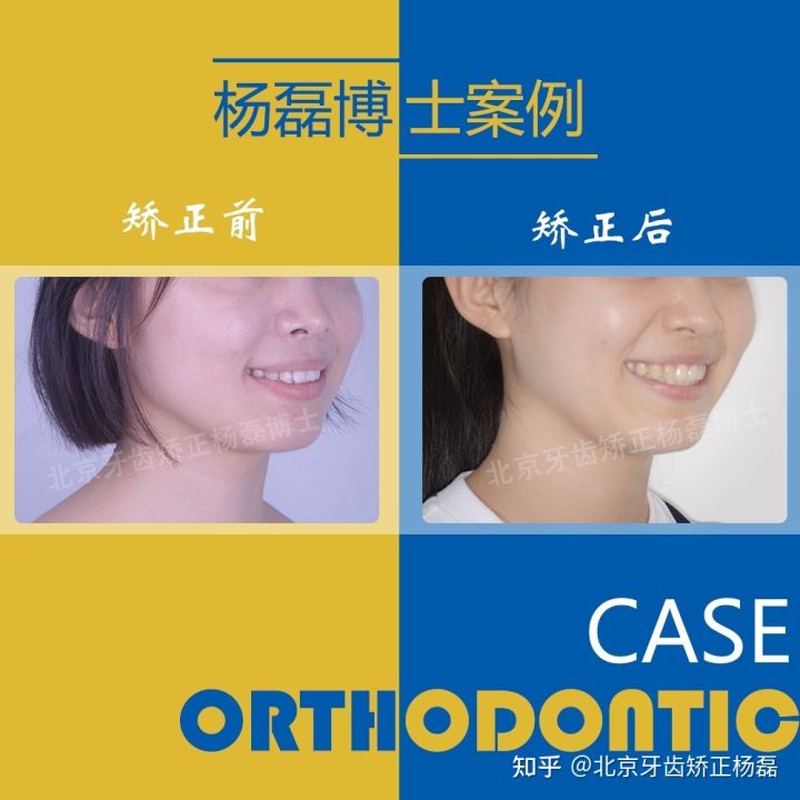 北京牙齿矫正大约要多少钱,北京哪个医院看牙齿矫正比较好