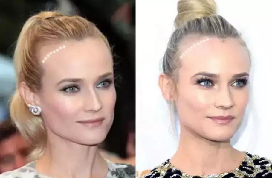 拯救发际线告别大额头,拯救发际线不走冤枉路