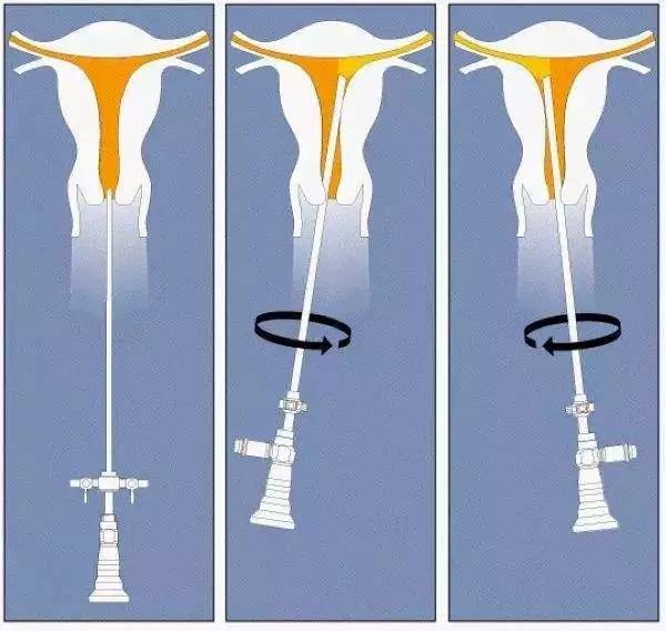 宫腔镜检查可怕吗,揭秘那些可怕的妇科检查