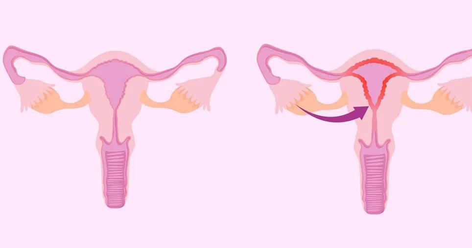 子宫壁薄医生不建议怀孕怎么办,子宫内膜薄可以怀疑吗