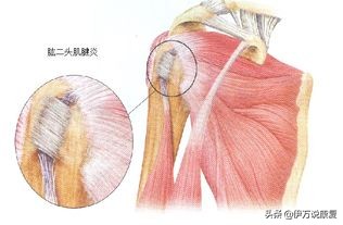 肩周炎:身“肩”重担,怎么治疗才能不带“炎”?