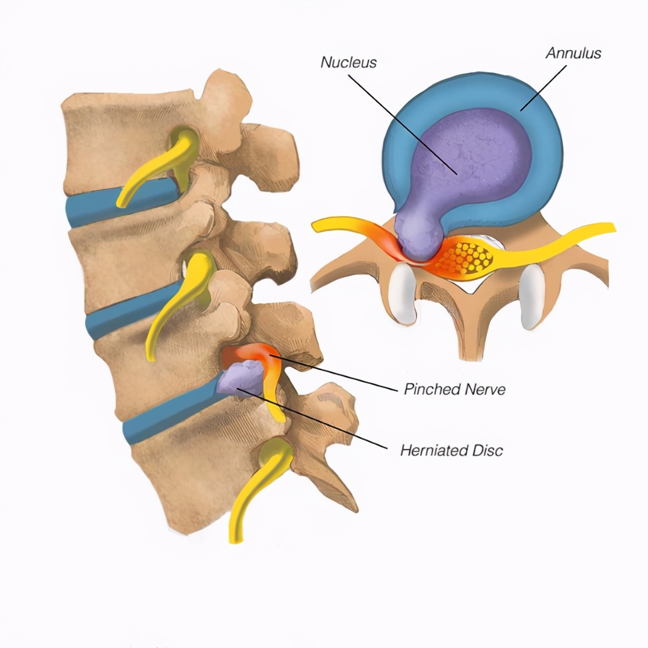 腰间盘突出症康复调理中药,腰间盘突出康复治疗怎么治