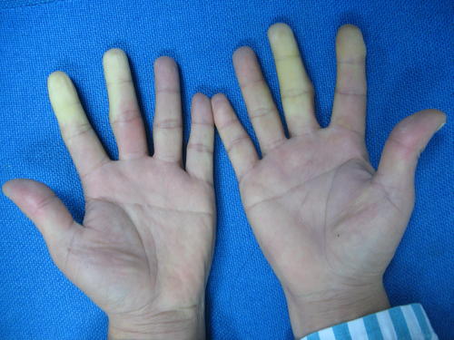 关于风湿病你了解多少,带您了解风湿病