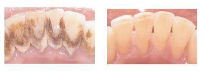 洗牙的过程是怎样的？洗牙有哪些注意事项呢？