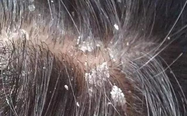 去屑洗发水深度测评六神,去屑止痒洗发水真实测评头屑多